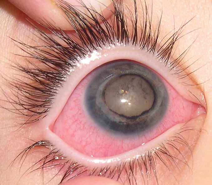 ET-contact-complications.jpg